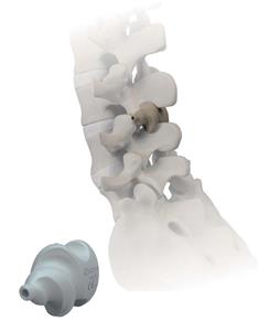 Helifix – interspinous spacer system 