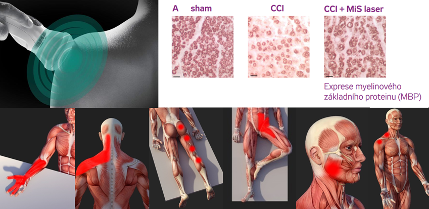 Pokročilé techniky v léčbě neuropatie, neuropatické a myofasciální bolesti